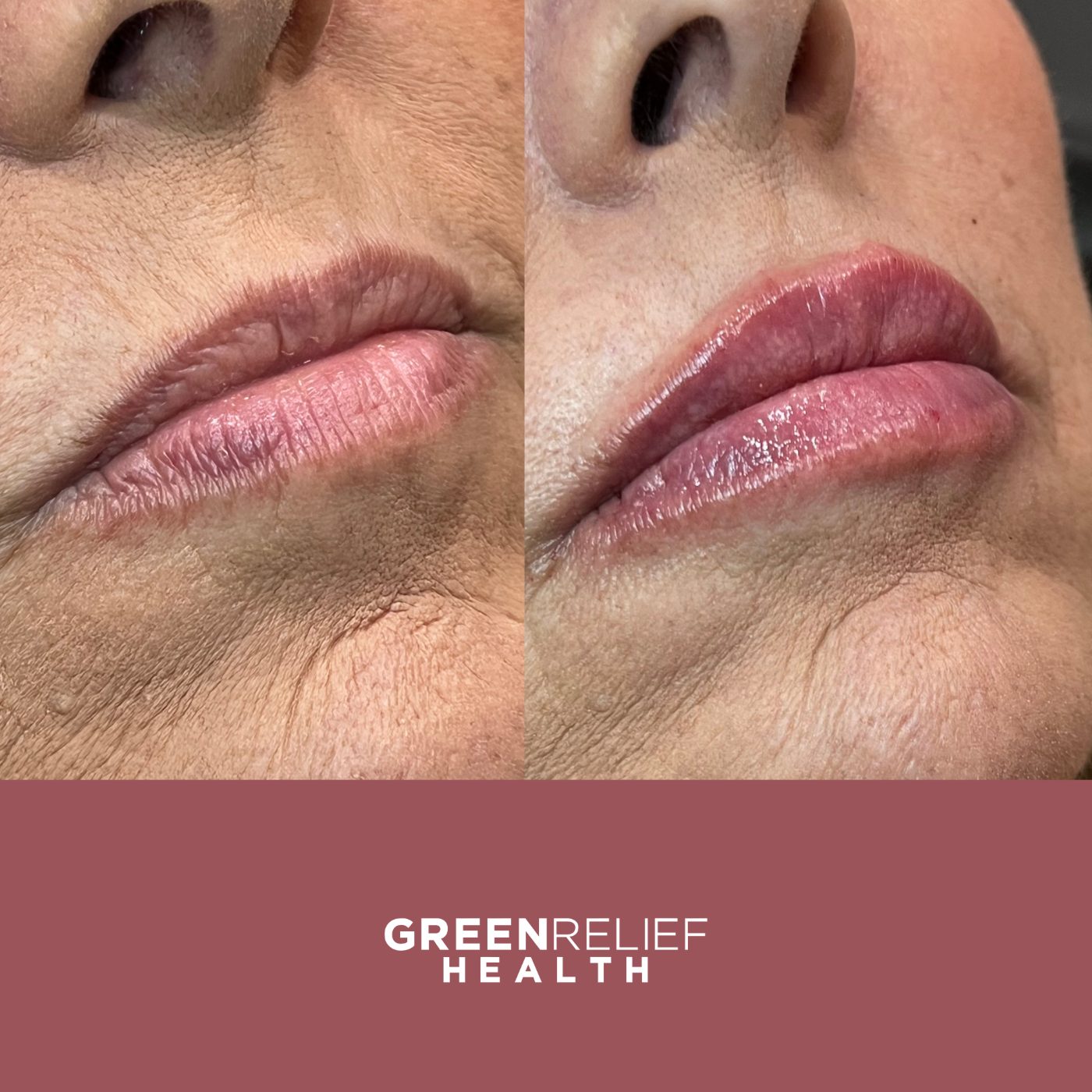 Before and after lip filler at Green Relief Health