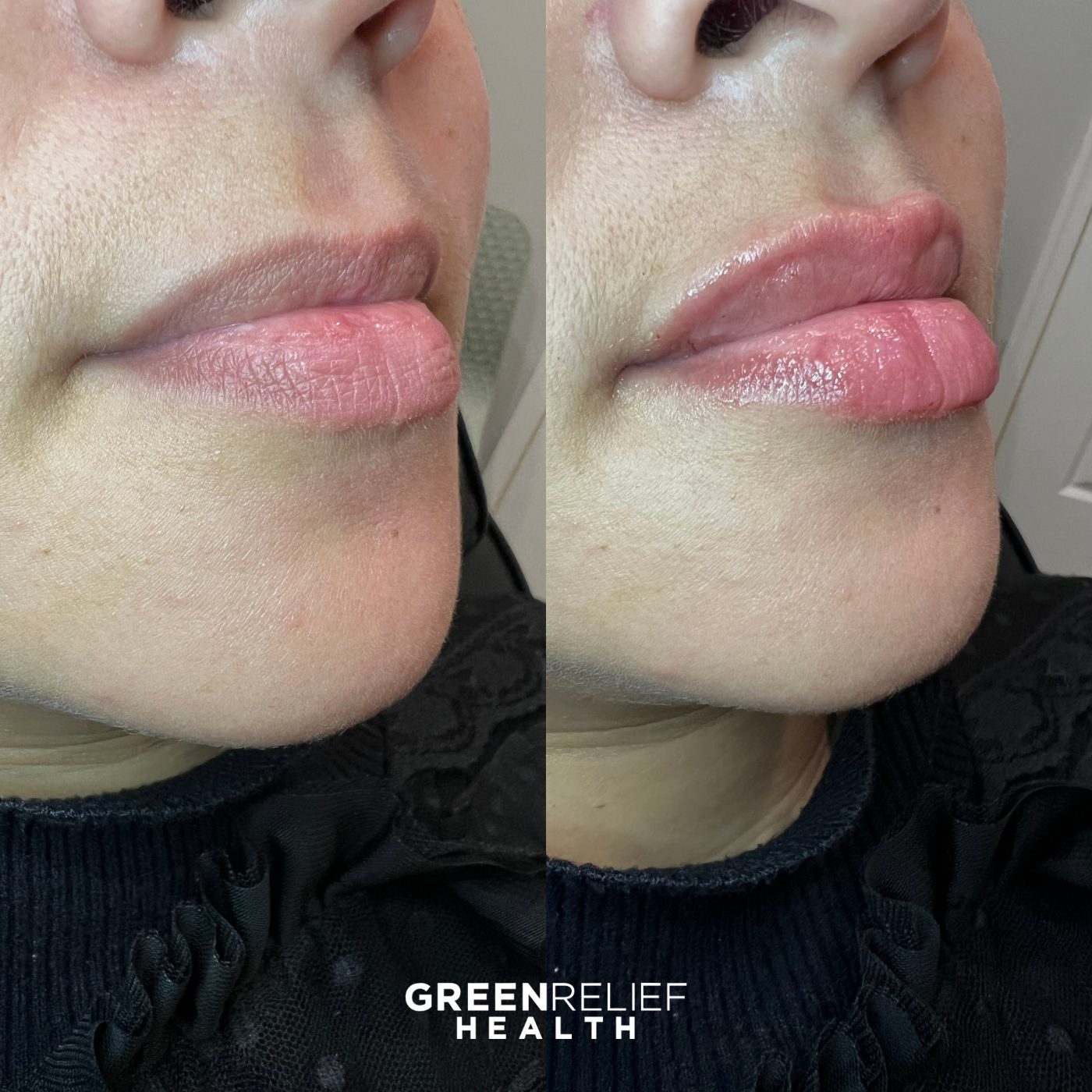 Before and after lip filler at Green Relief Health