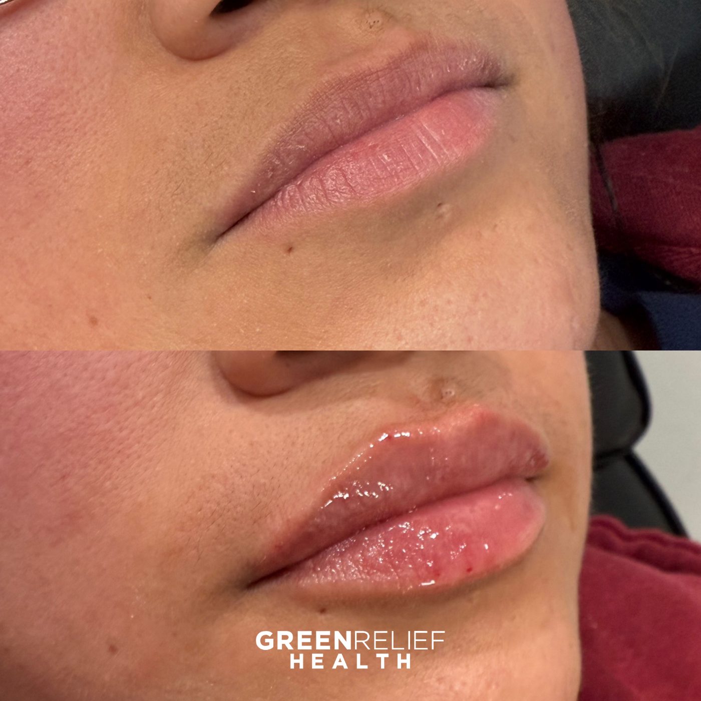 Before and after lip filler at Green Relief Health