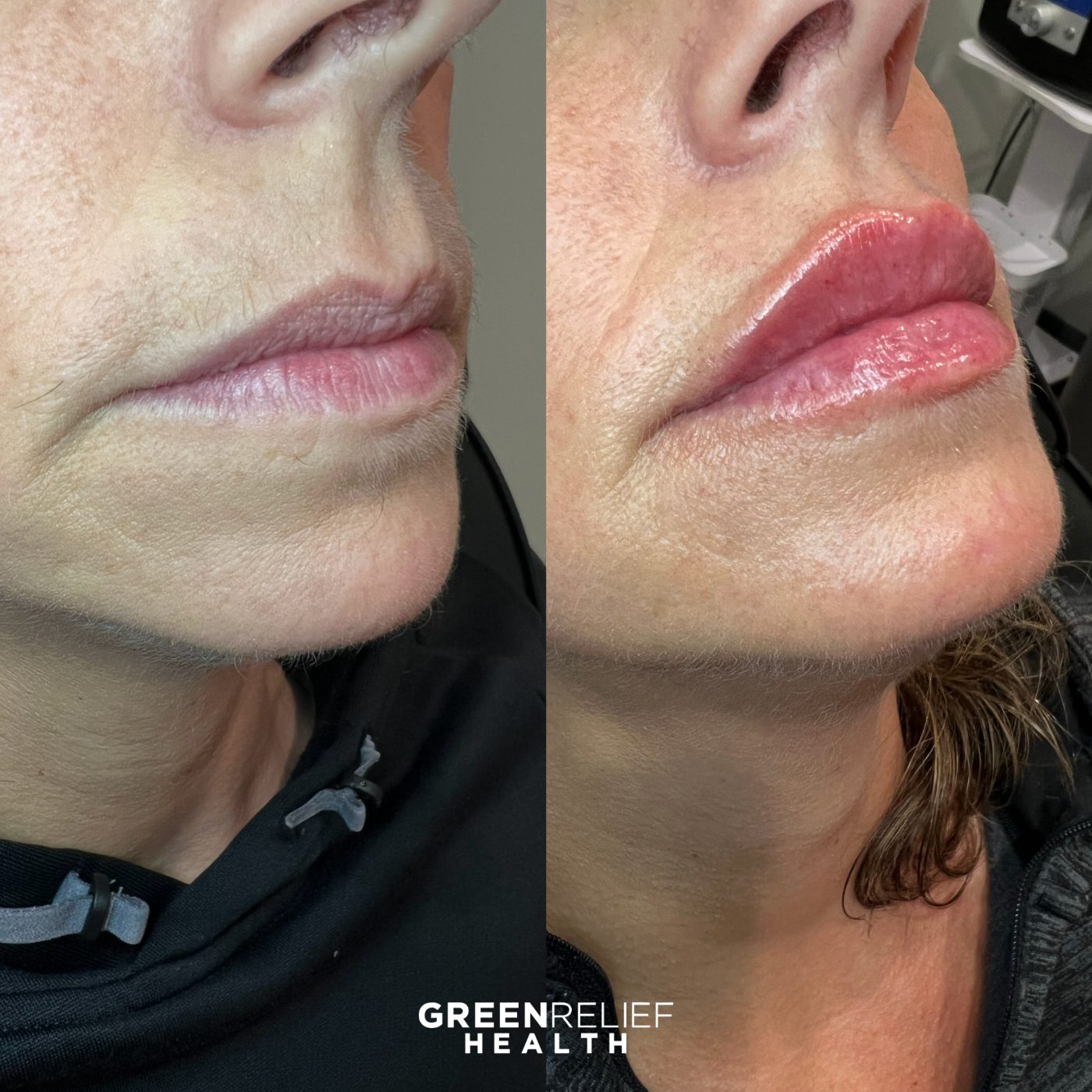 Before and after lip filler at Green Relief Health