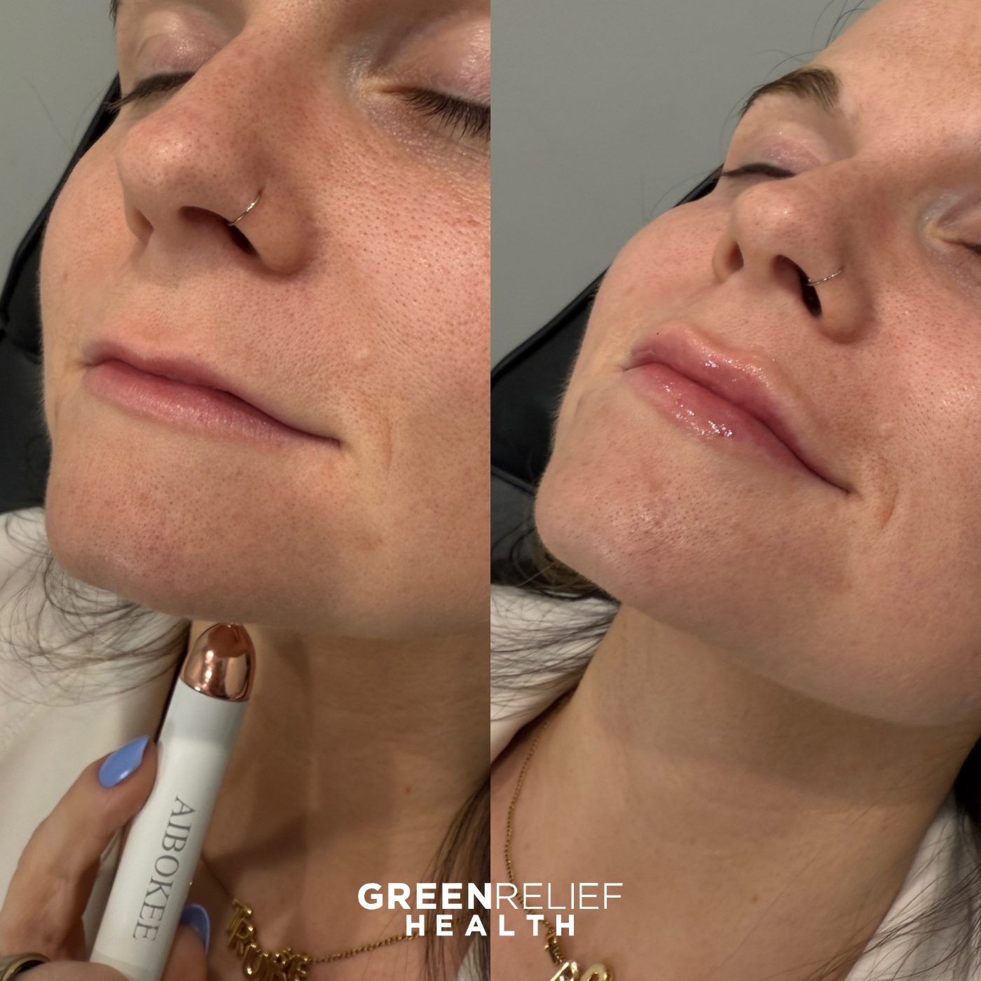 Before and after lip filler at Green Relief Health