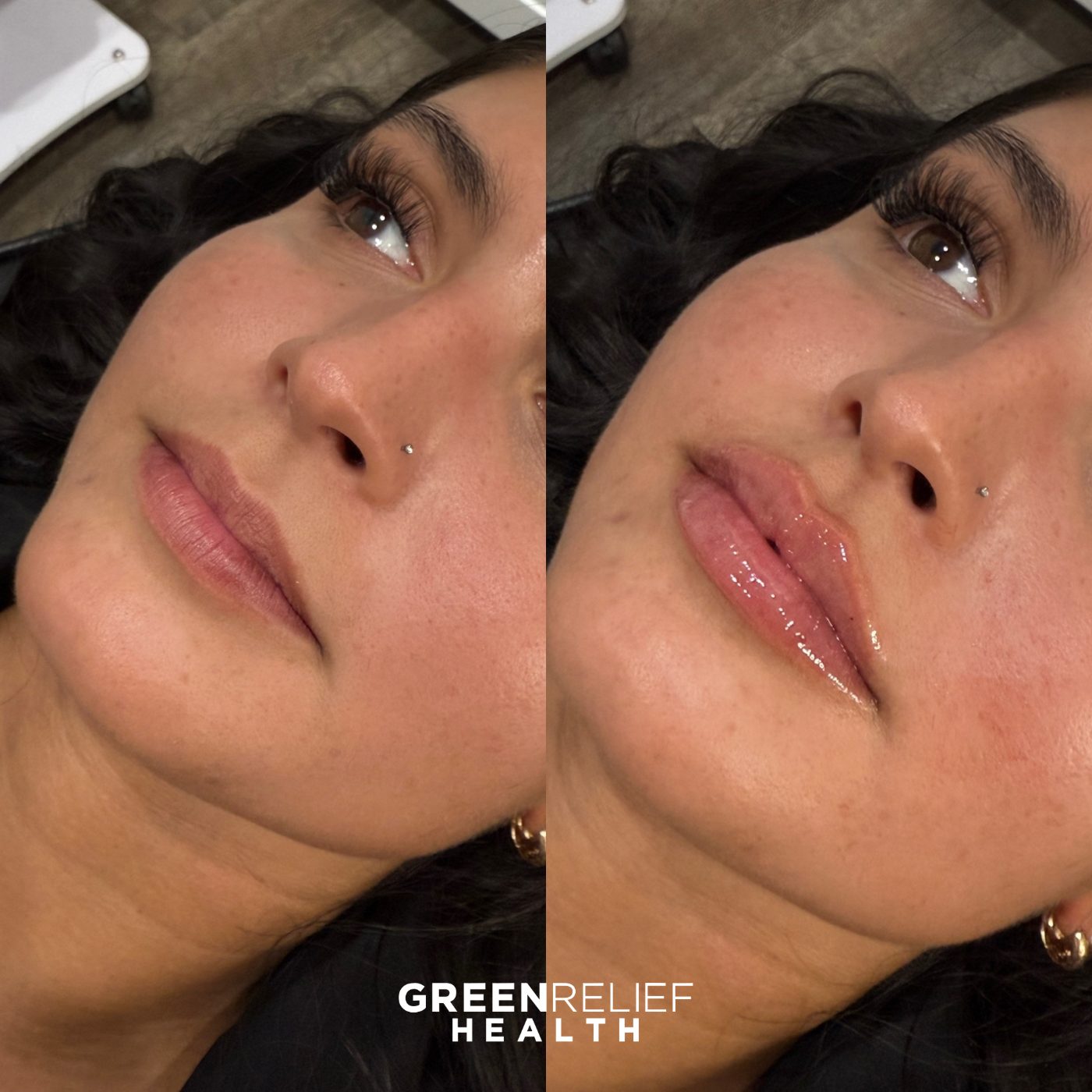 Before and after lip filler at Green Relief Health