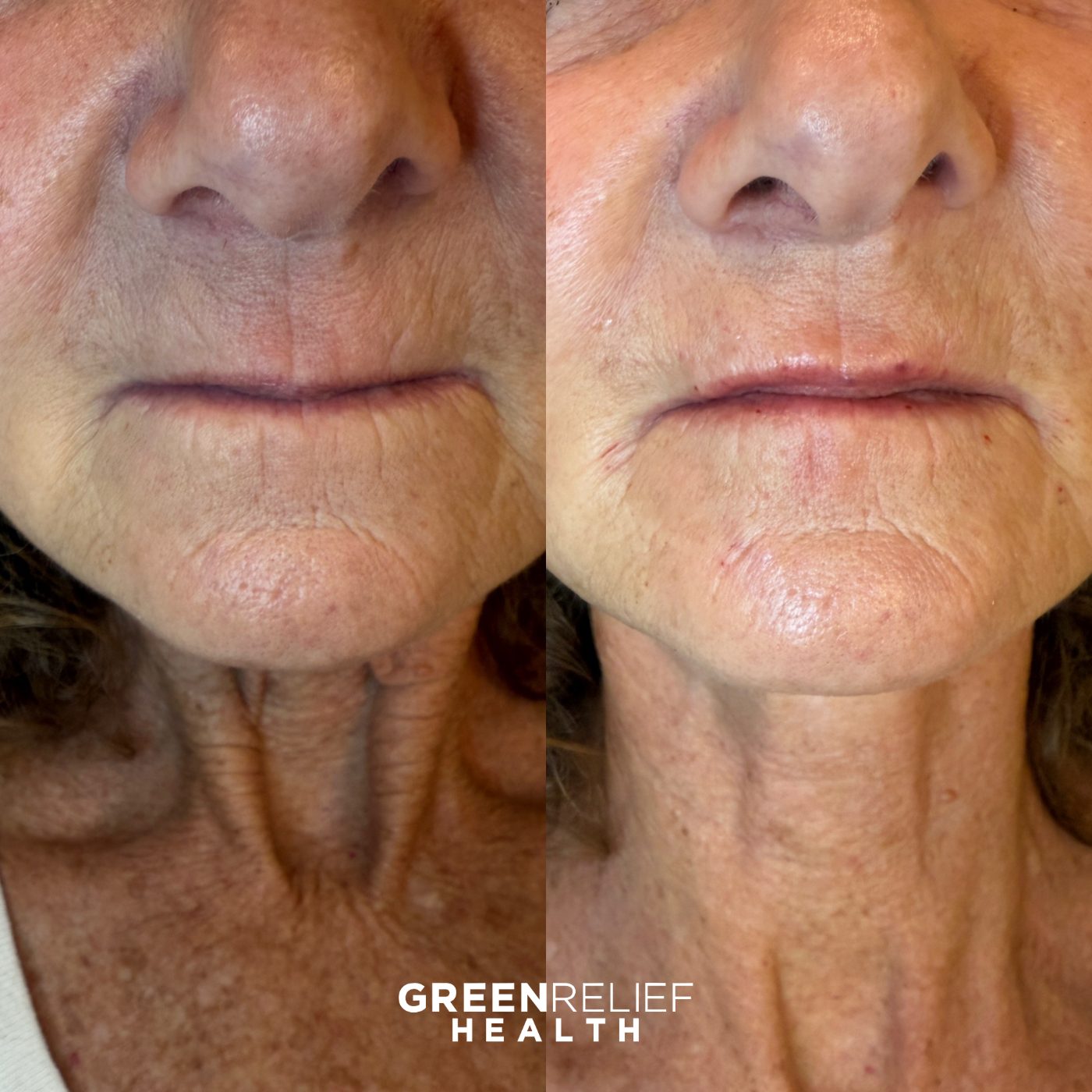 Before and after lip line filler at Green Relief Health