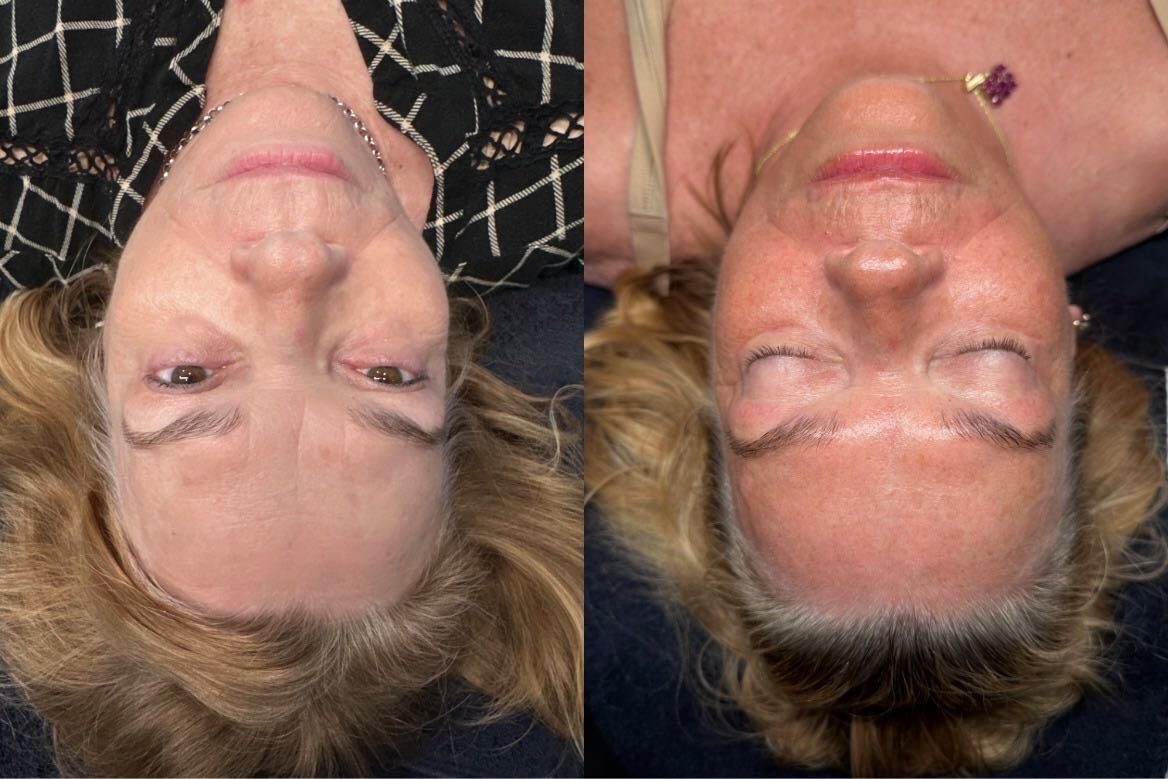 Before and after microneedling at Green Relief Health