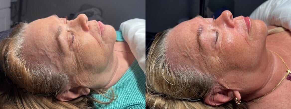 Before and after microneedling at Green Relief Health