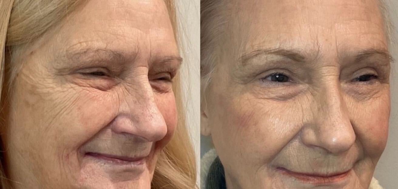 Before and after microneedling at Green Relief Health