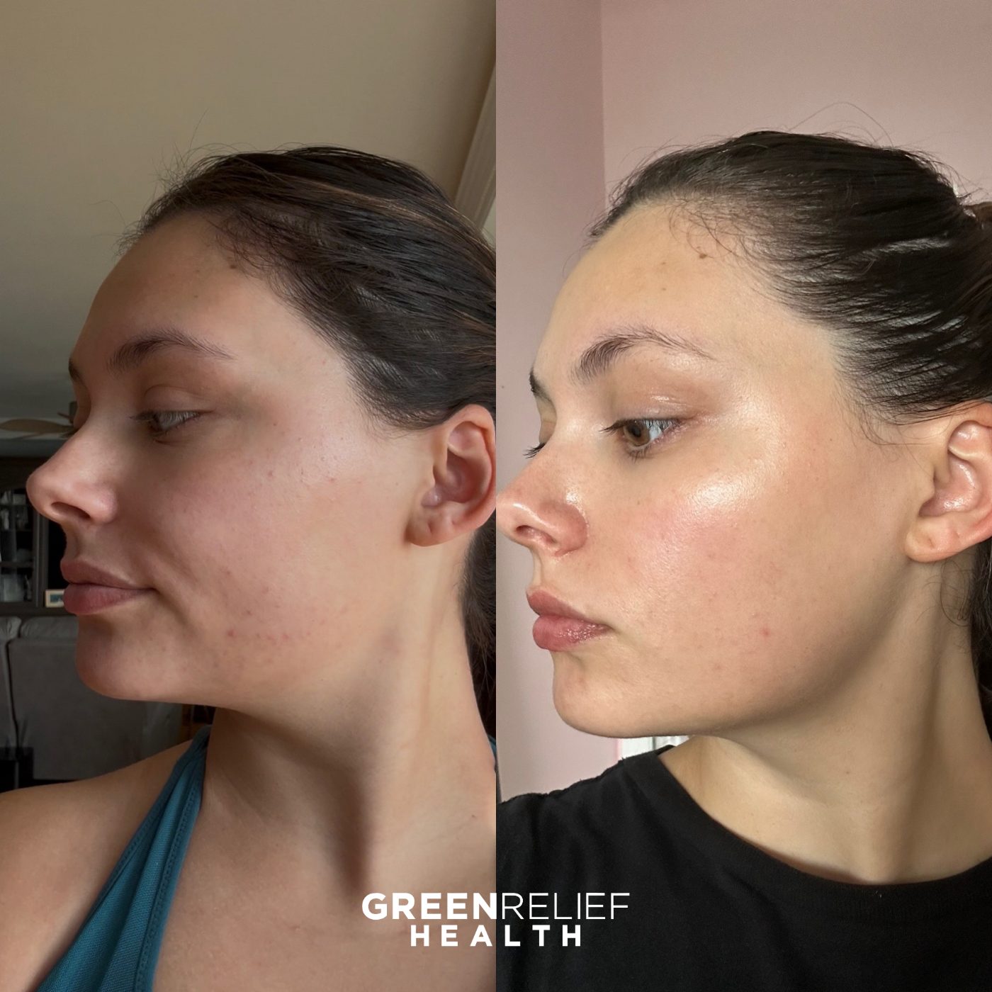 Before and after microneedling at Green Relief Health