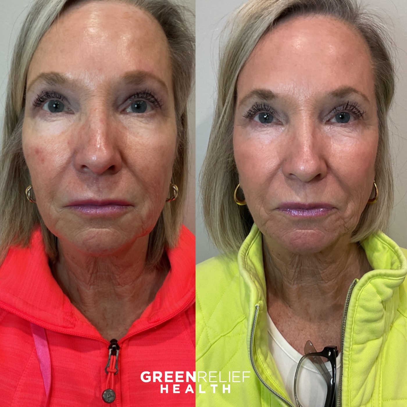 Before and after microneedling at Green Relief Health