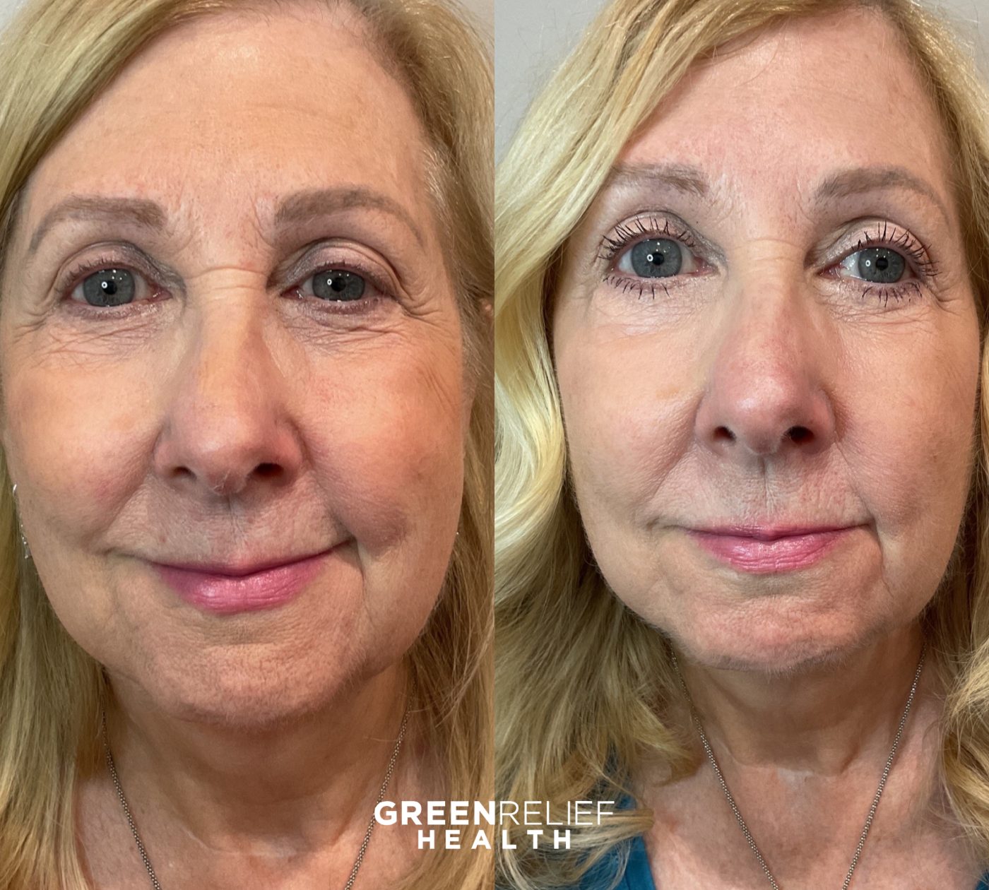 Before and after microneedling at Green Relief Health