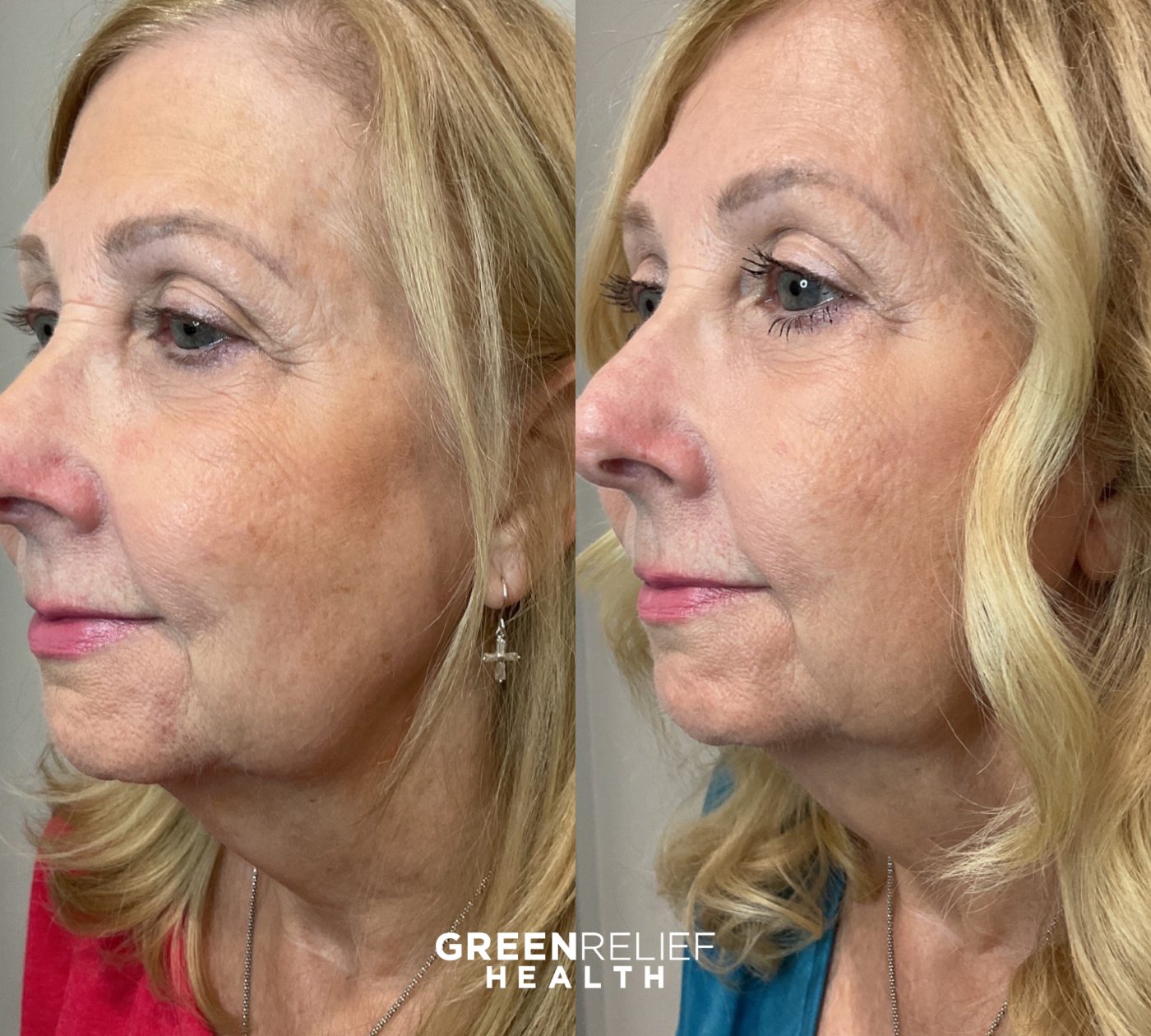 Before and after microneedling at Green Relief Health