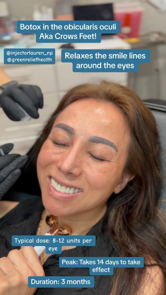 Botox in the orbicularis oculi, aka crow’s feet