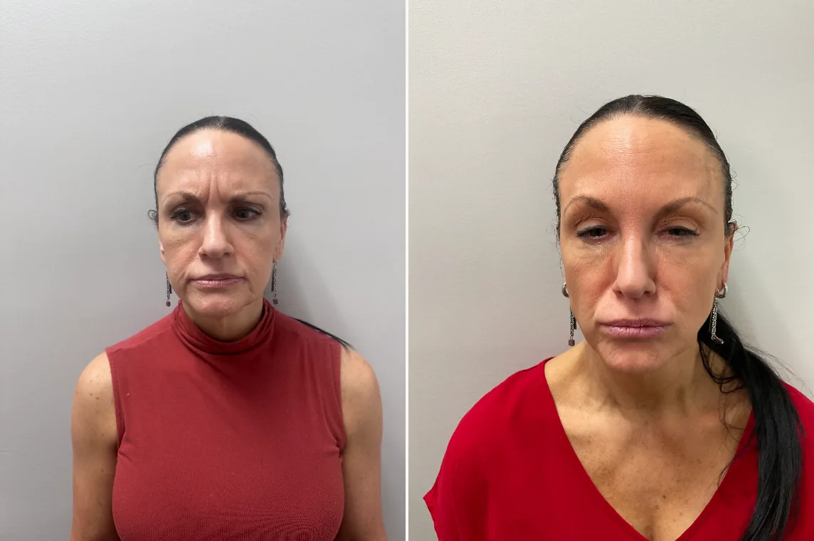 Before and after Botox treatment showing muscle relaxation and wrinkle reduction